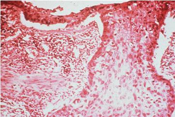 basal cells spreading